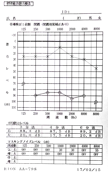 对类固醇/异烟肼药物无反应的听力损失的听力检查。