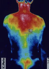 ウイルス感染が原因の左耳突発性難聴｜サーモ画像