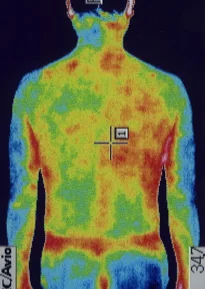 ストレスが原因の左耳突発性難聴｜サーモグラフィ画像