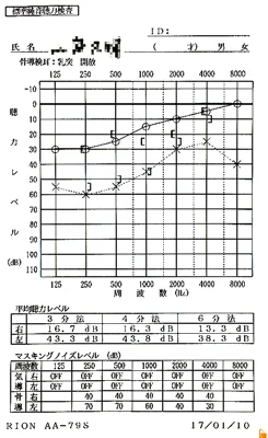 突発性難聴｜発症から5ヵ月経過