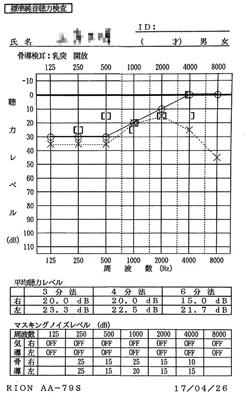 突発性難聴｜発症から8ヵ月経過