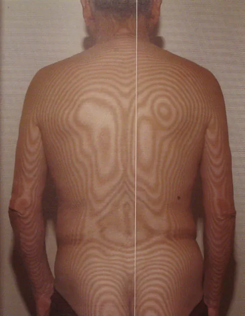 治療前のサーモグラフィ画像