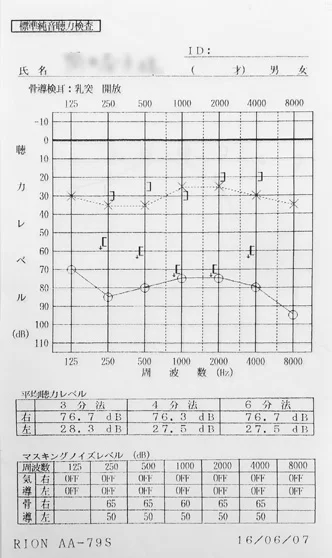 ラムゼイハント症候群|鍼治療前の聴力が低下しているオージオグラム