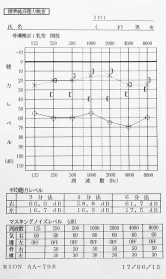 ラムゼイハント症候群|鍼治療と音響療法で聴力が改善したオージオグラム