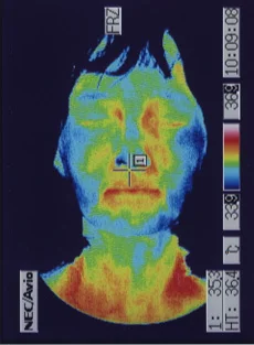 治療後のサーモグラフィ画像