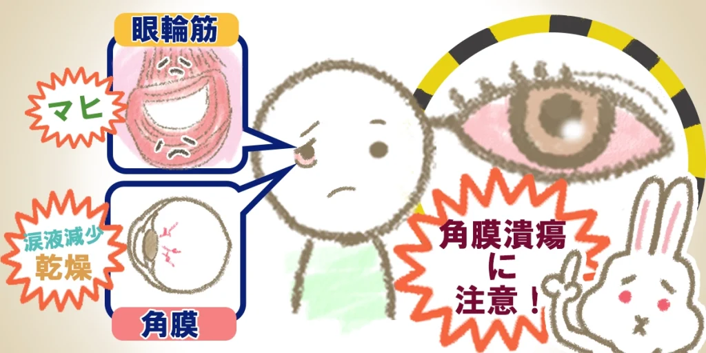 兎眼になる理由と、角膜潰瘍の注意を促すイラスト