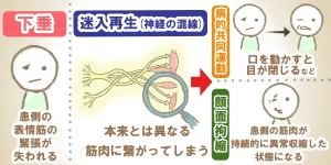 顔面神経麻痺による顔が歪むメカニズムをイラストで図解